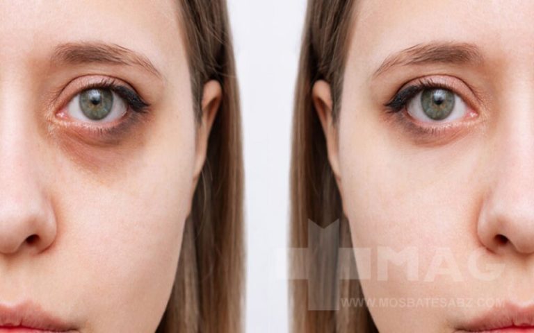 علائم کبد چرب در چهره چیست؟