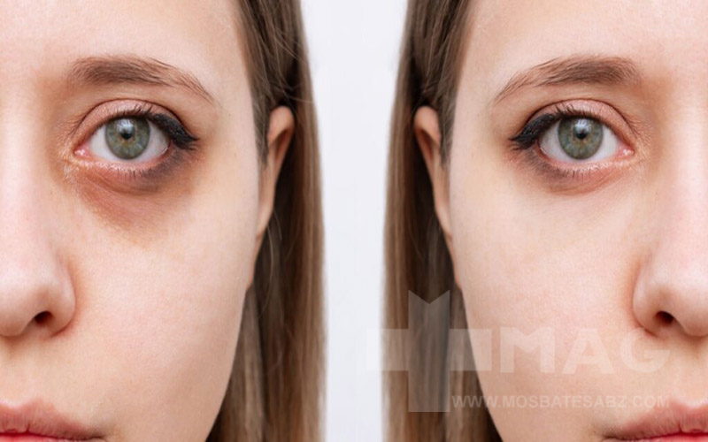 علائم کبد چرب در چهره چیست؟