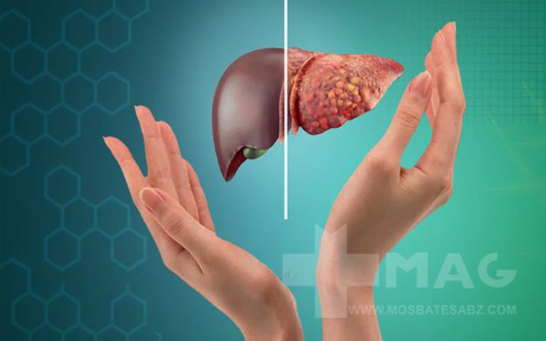 علائم کبد چرب که نباید آن‌ها را ناد