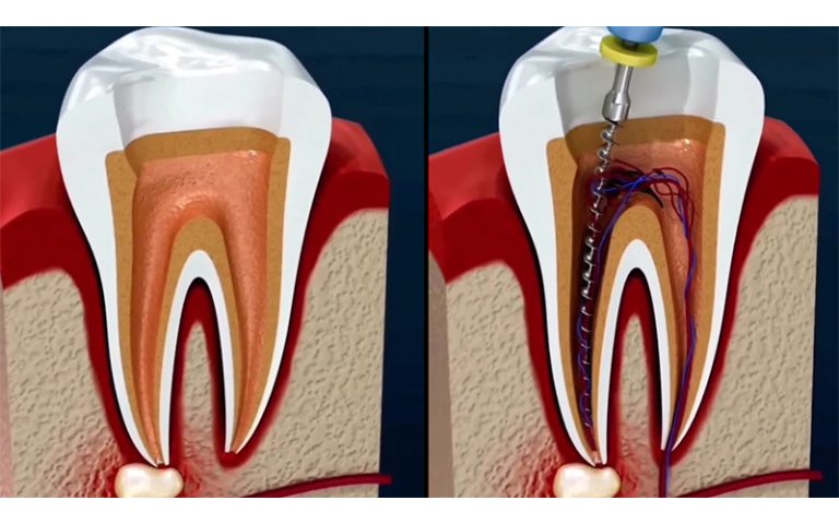 قبل از عصب کشی دندان چه قرصی بخوریم؟