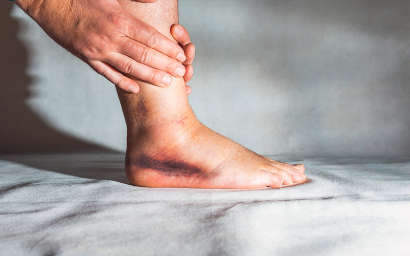 تورم روی مچ پا نشانه چیست