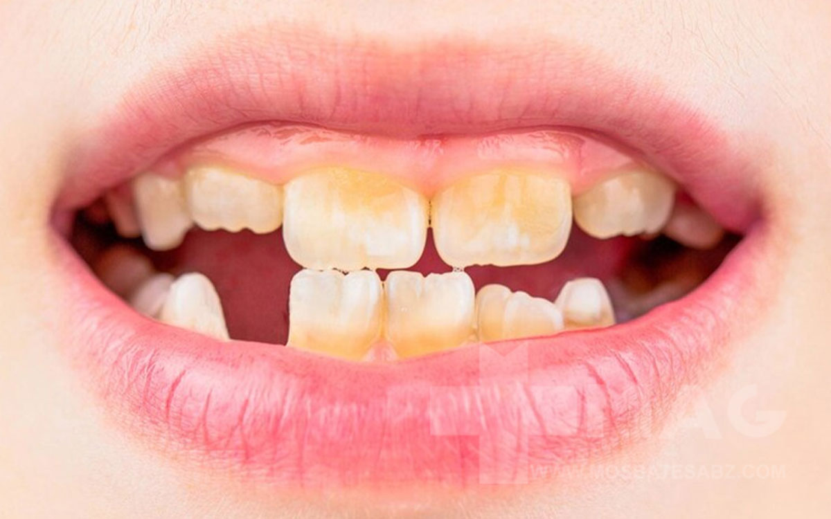 فرسایش مینای دندان