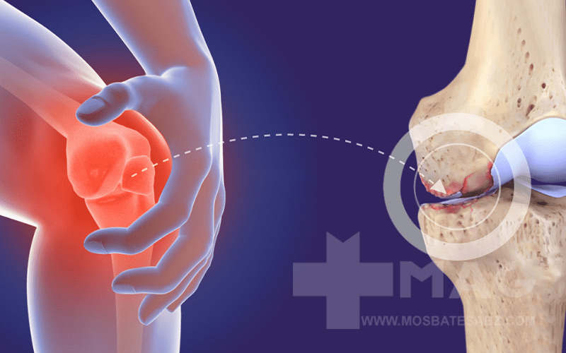 ورزش برای روماتیسم