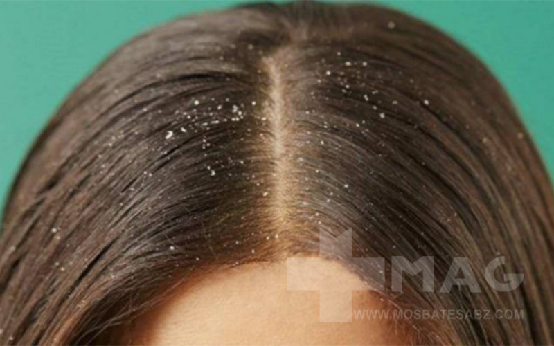 همه چیز درباره شوره سر