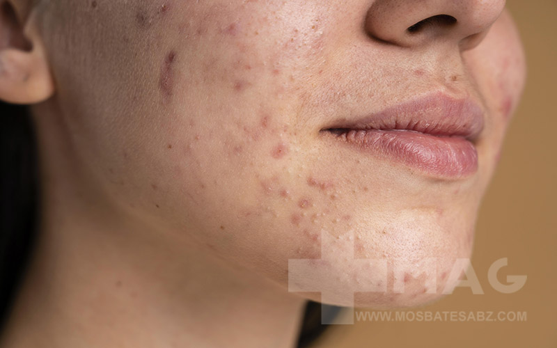 دلایل جوش زدن زیاد پوست