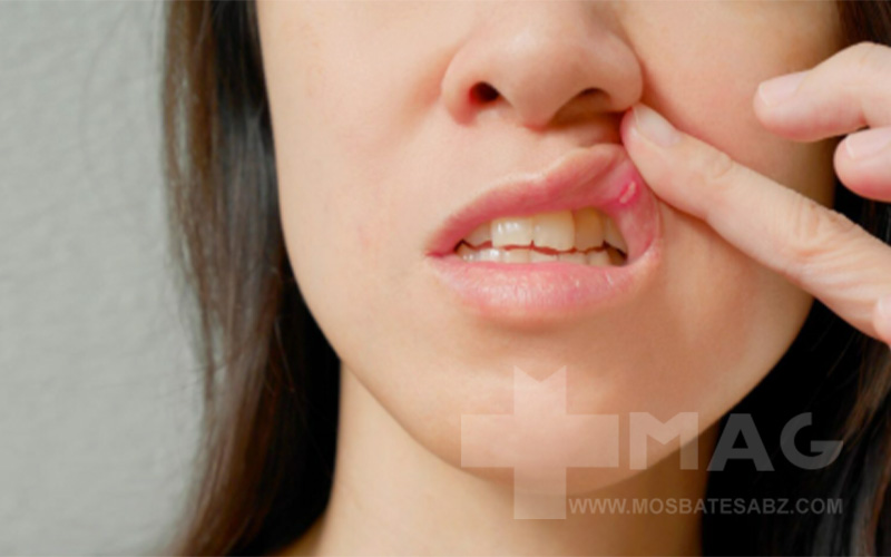 علائم زگیل تناسلی