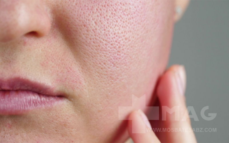 چه دوزی برای درمان آکنه بهتر عمل میکند؟