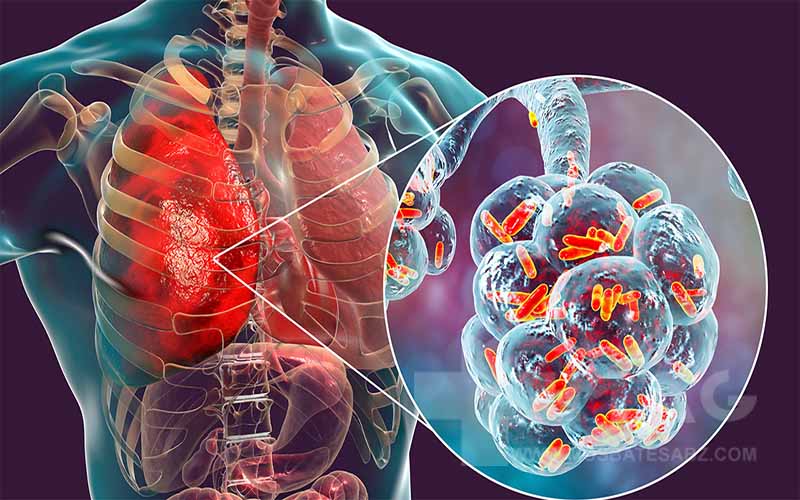 عفونت ریه چیست؟