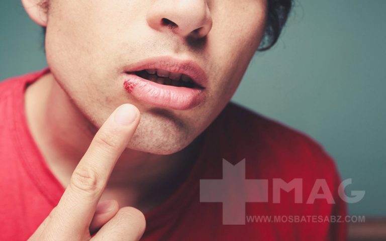 درمان یک روزه تبخال لب