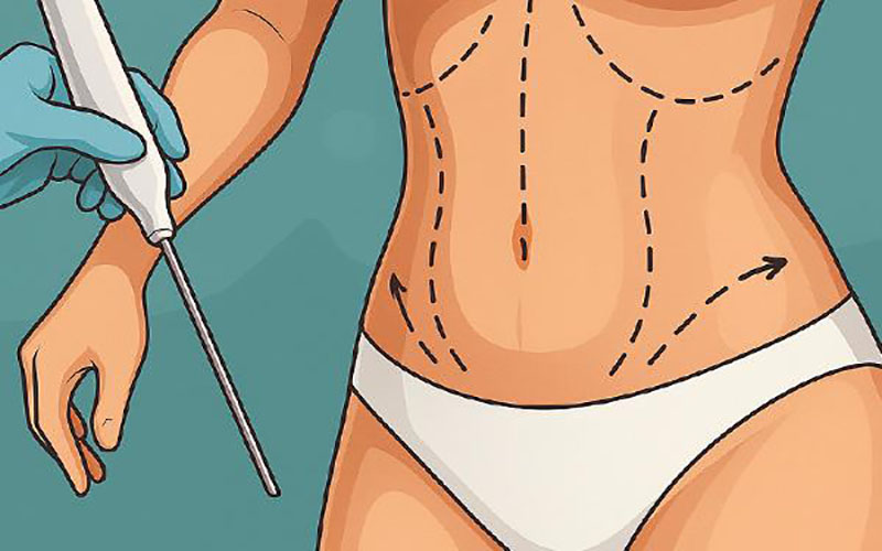 بررسی این‌که ویزر لیپو چیست