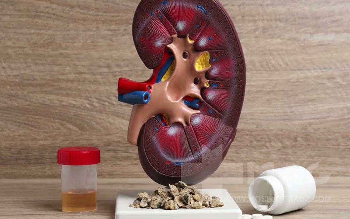 سنگ کلیه و مثانه