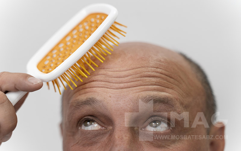 تفاوت ریزش موی هورمونی و ارثی