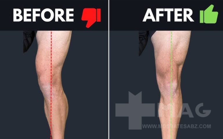 حرکات اصلاحی پای پرانتزی