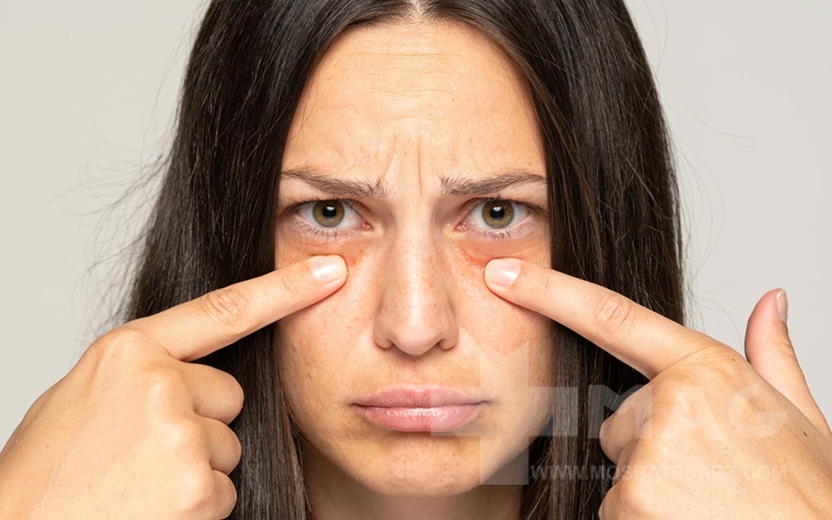 پف زیر چشم و مشکلات کبدی