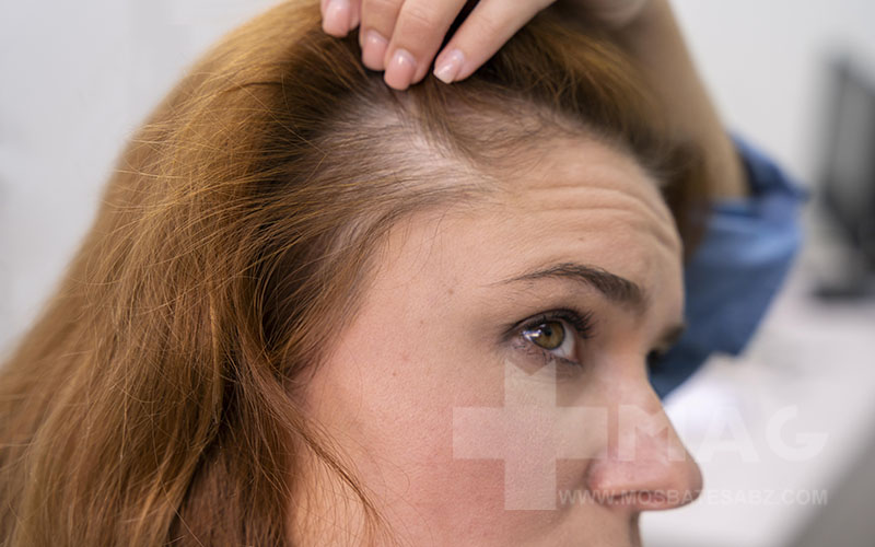 زنان هم هورمون DHT دارند که باعت ریزش