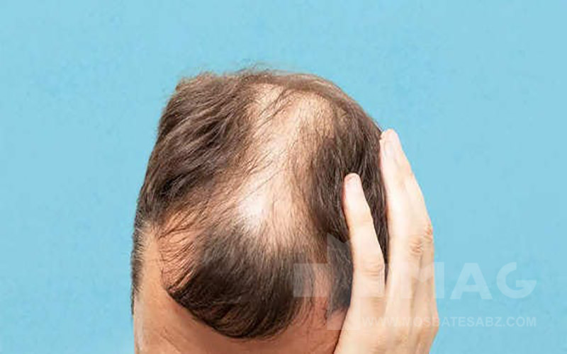 راهنمای کامل ریزش مو آندروژنیک