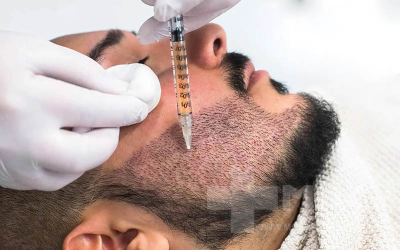 تزریق کورتیکواستروئیدهای موضعی