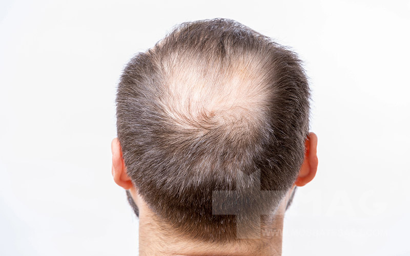 ریزش مو از پشت سر