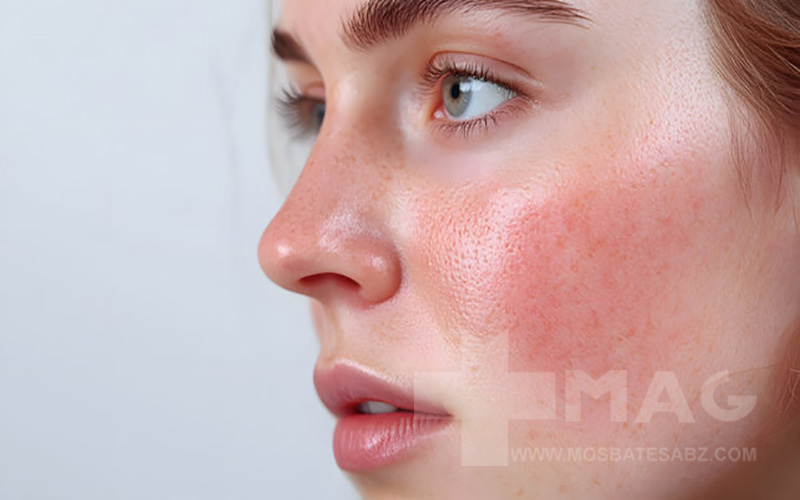 تسکین التهاب پوست