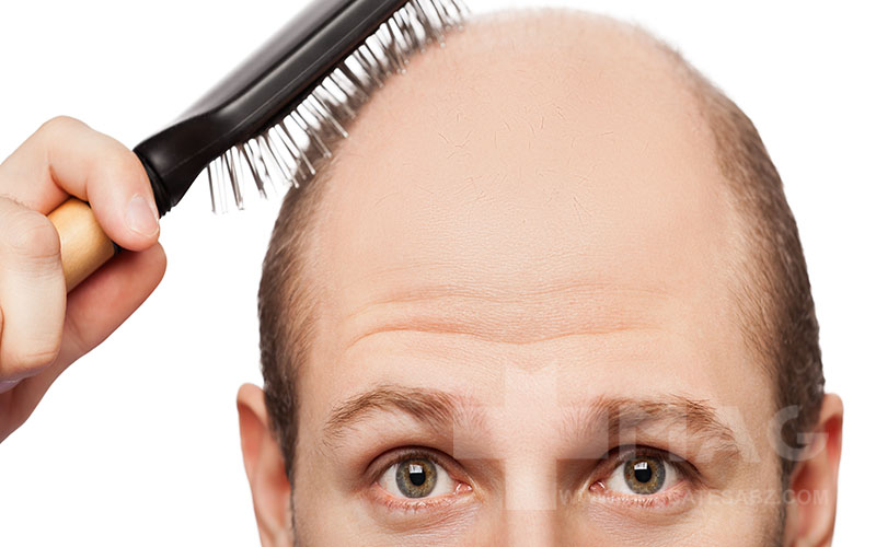 راهنمای کامل درمان ریزش مو در مردان