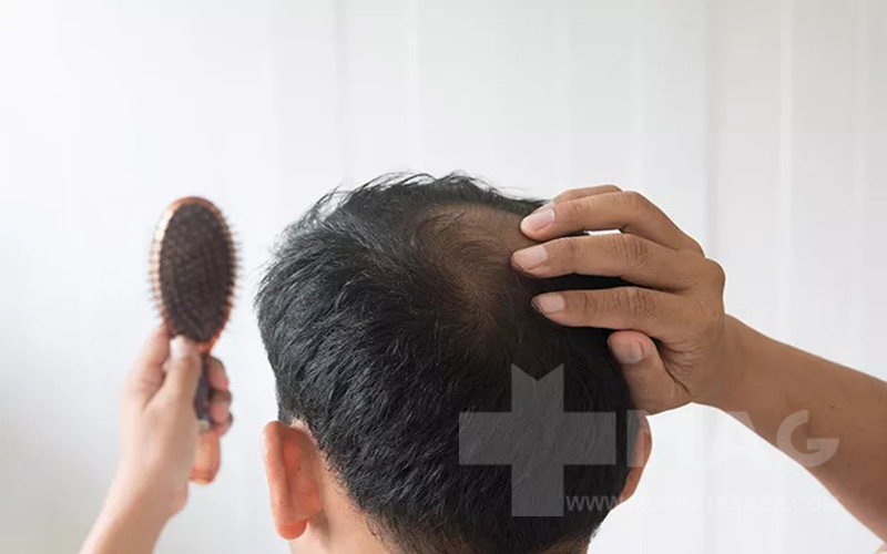 نقش رژیم غذایی درقطع ریزش مو