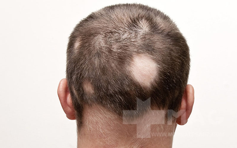 آلوپسی آره‌آتا