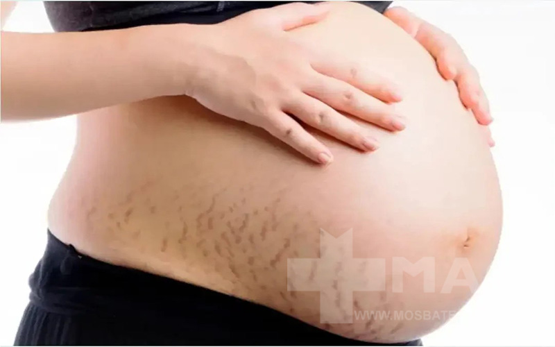 پذیرش تغییرات پوستی در بارداری