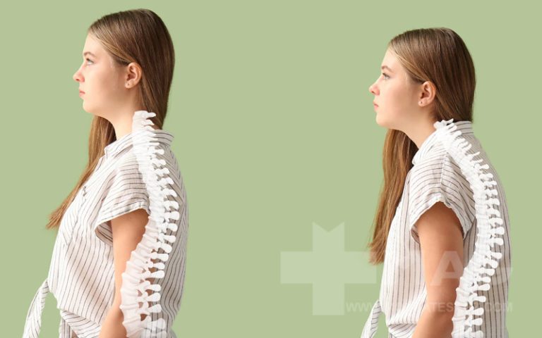 حرکات بدنسازی برای رفع قوز کمر