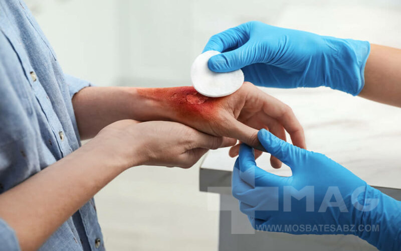 محصولات دارویی و تخصصی برای درمان سوختگی