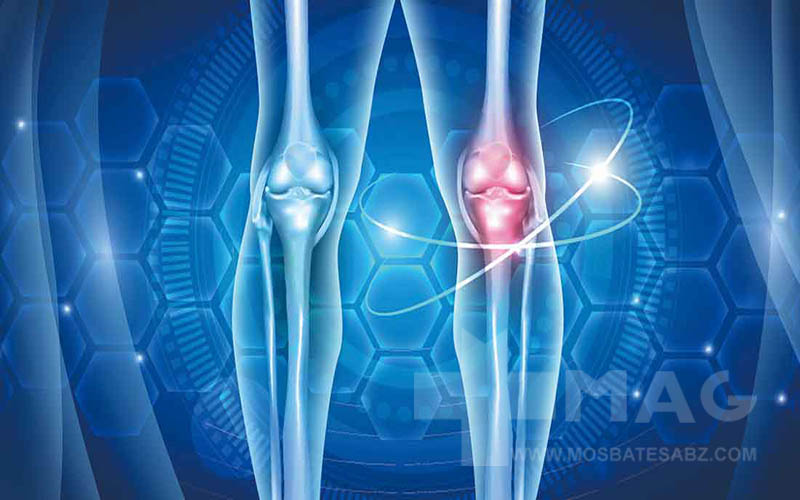 بهترین مکمل برای آرتروز زانو کدام است؟