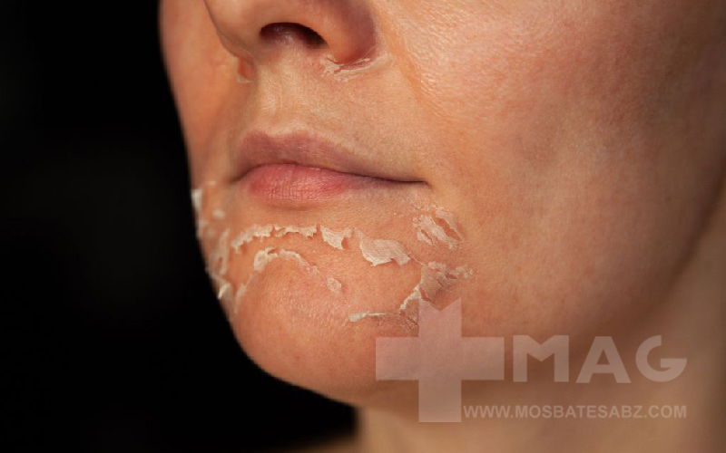 حساسیت پوستی بعد از زدن آبرسان