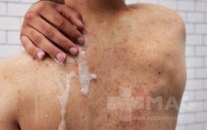 بهترین شوینده بدن جوش دار