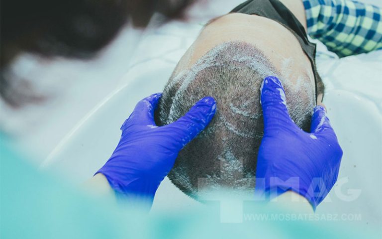 بهترین شامپو برای بعد از کاشت مو