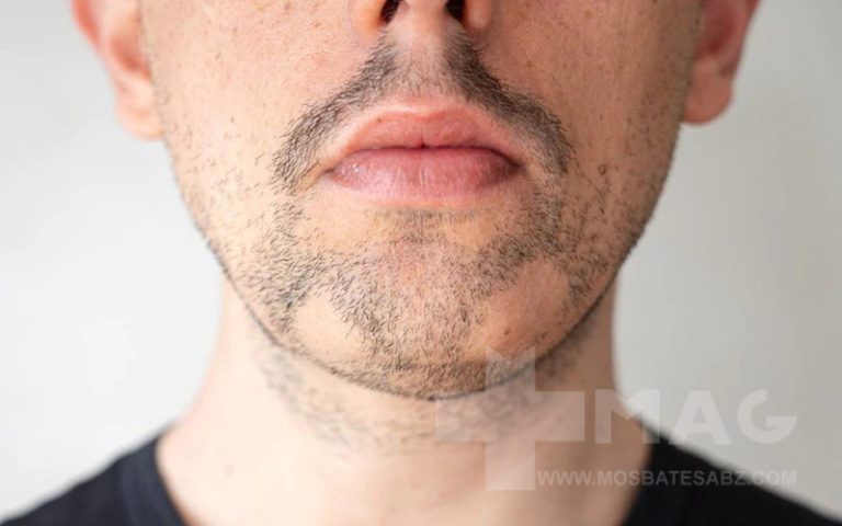 ریزش سکه ای ریش