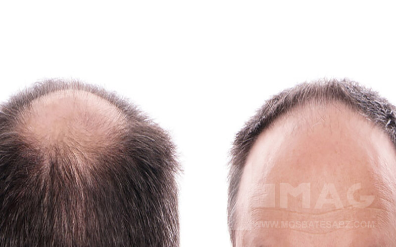 تأثیر سن بر شدت و نوع ریزش مو