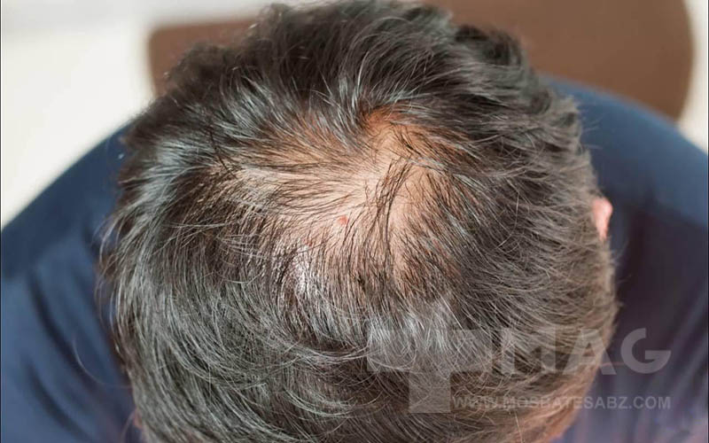 اثر کورتیزول بر فولیکول‌ها