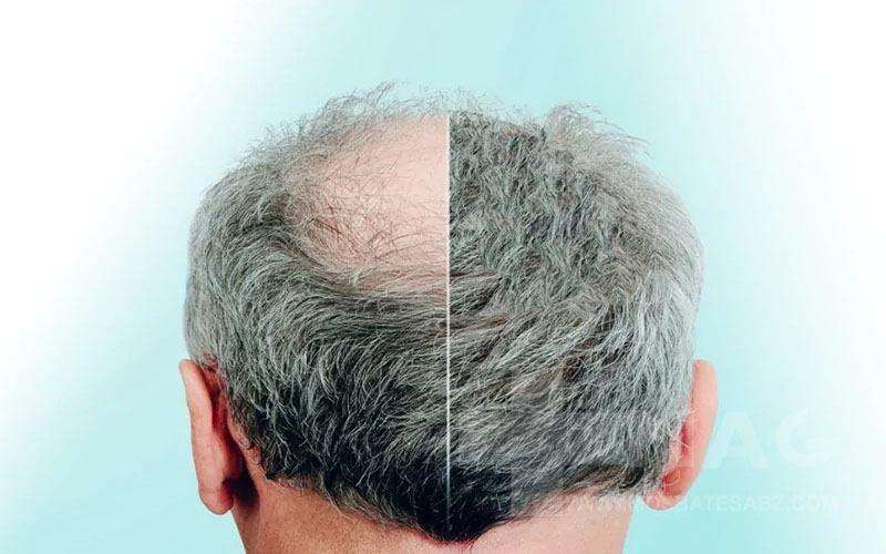 علت ریزش مو در مردان