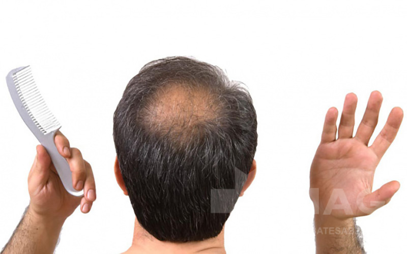 چرا ریزش مو در مردان بالای ۴۰ سال شایع‌تر است؟