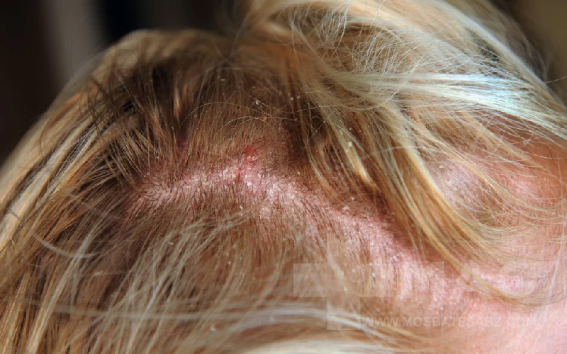 آلرژی و حساسیت‌های پوستی از عوارض ماسک مو