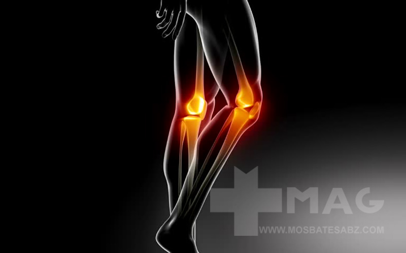 بهترین مکمل برای آرتروز زانو کدام است