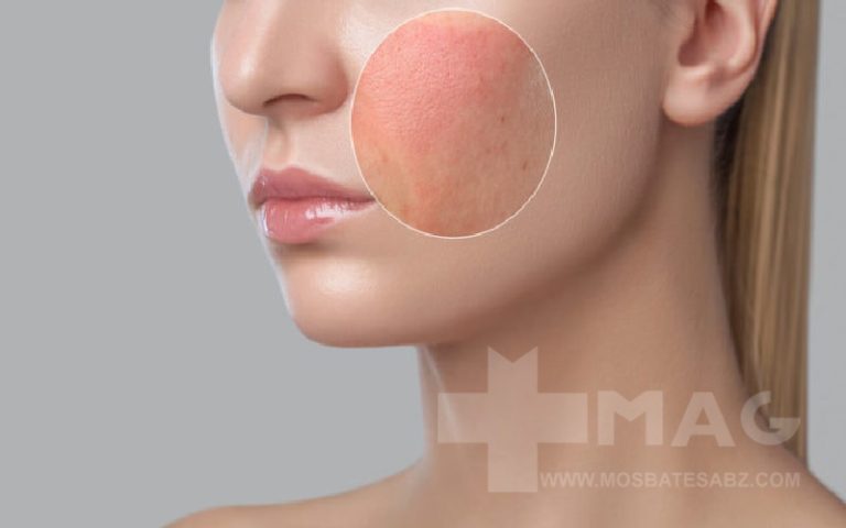 علت سوزش پوست بعد از زدن آبرسان