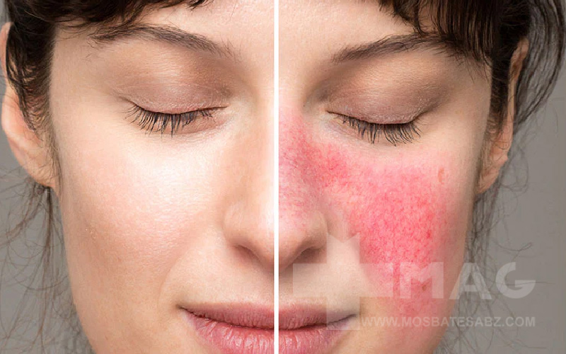 تفاوت بین واکنش حساسیتی و سوزش طبیعی پوست