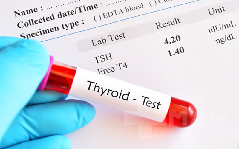 آزمایش تیروئید و 7 فاکتور آن