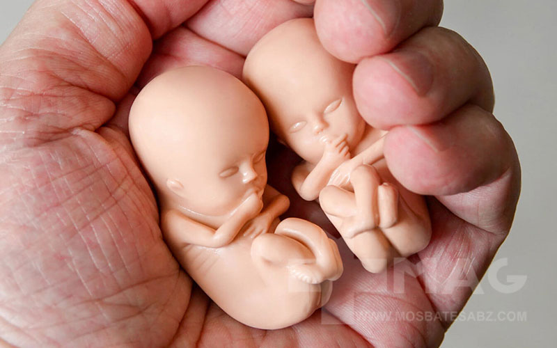 سقط جنین دوقلو