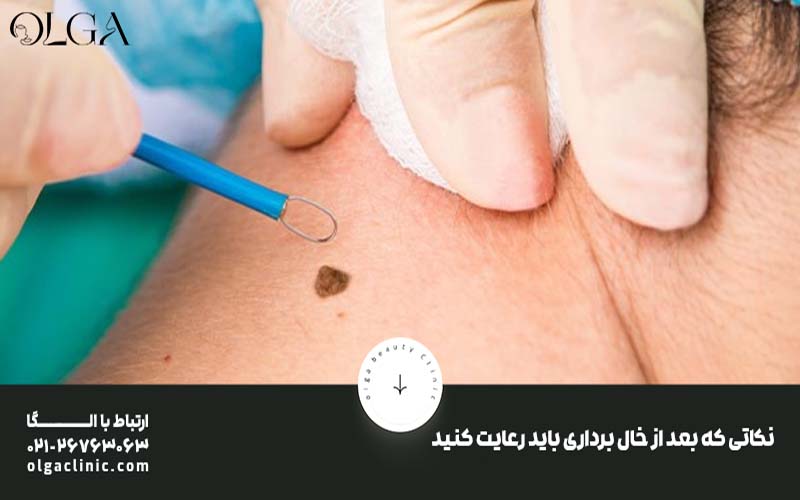 نکاتی که بعد از خال برداری باید رعایت کنید: