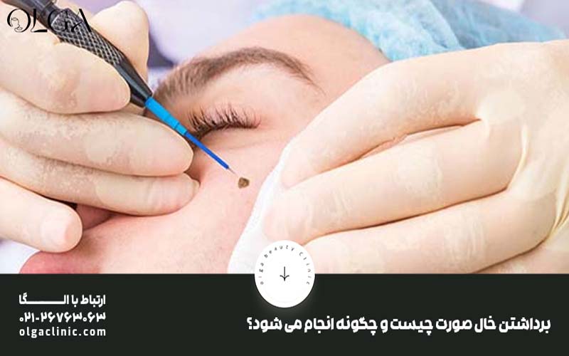 برداشتن خال صورت