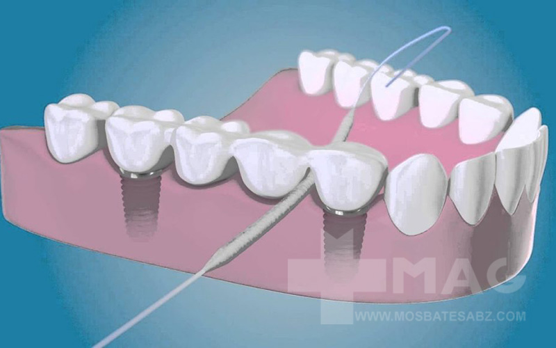 راهنمای کشیدن نخ دندان برای دندان روکش شده