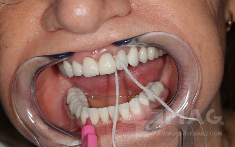 نحوه کشیدن نخ دندان روکش شده