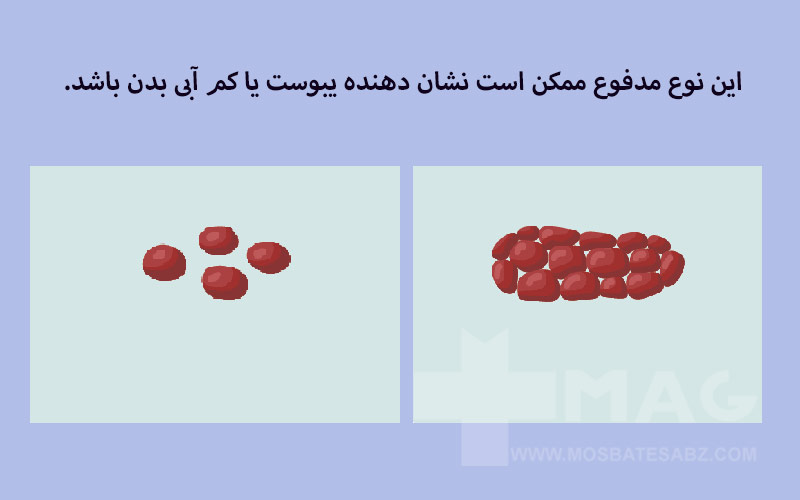 تصویری از انواع مدفوع که می‌تواند به معنای ابتلا به یبوست باشد.