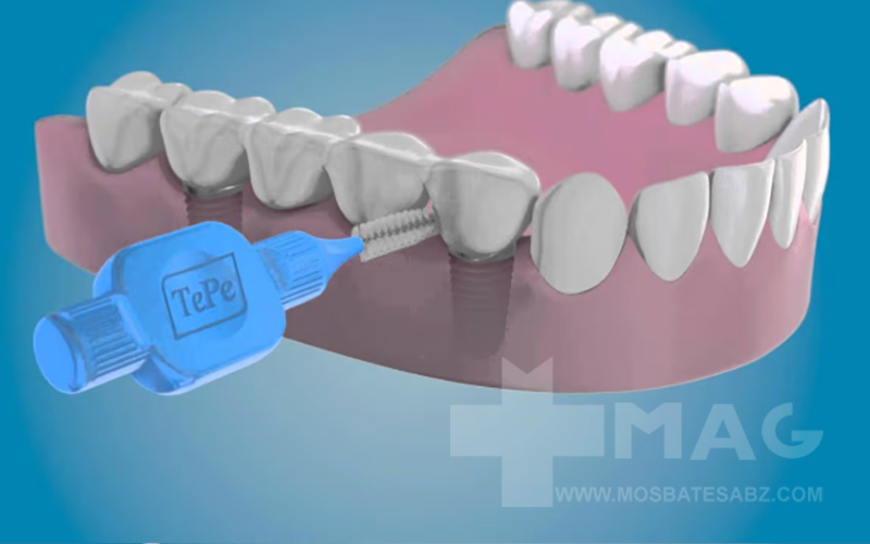 بهترین جایگزین نخ دندان برای دندان روکش شده
